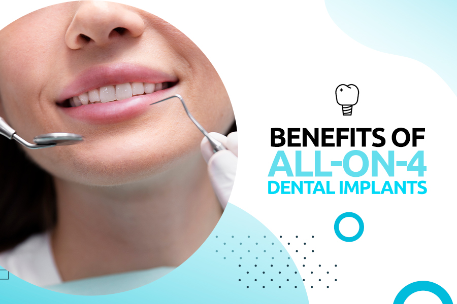 Benefits of All on 4 Dental Implants