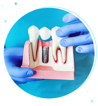 Are There Age Restrictions for Getting Dental Implants