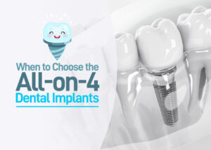 When to Choose the All-on-4 Dental Implants